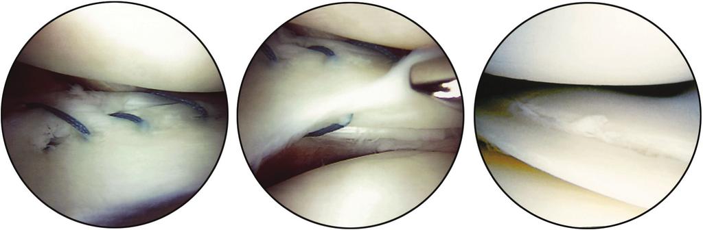 2402 PART XIV ARTHROSCOPY Bucket-handle tear A B FIGURE 51-15 A, Bucket-handle tear of medial meniscus that has flipped into intercondylar notch; in this position, meniscus may cause intermittent