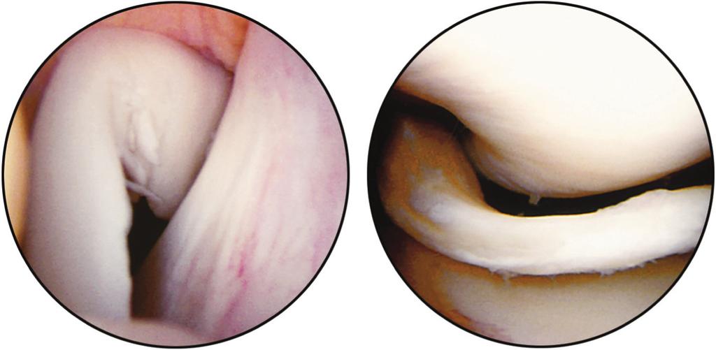 B, Incomplete undersurface tear of medial meniscus; this can be treated with abrasion to stimulate local healing followed by placement of one or two sutures.