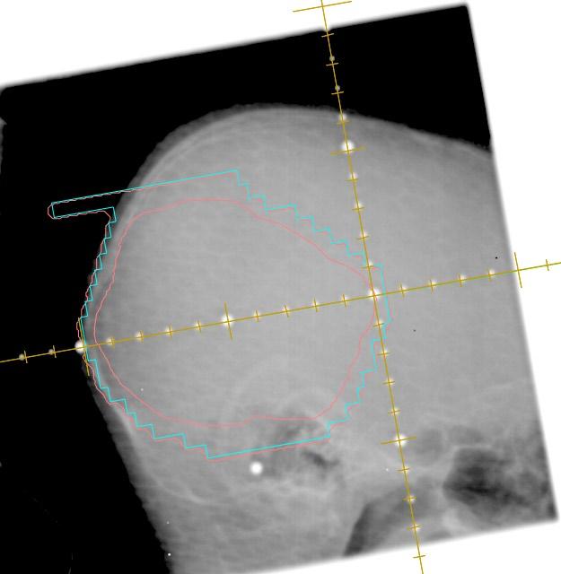 208 Tam et al.: Reducing radiation in tumor imaging 208 Fig. 3. Example of a treatment field portal image.
