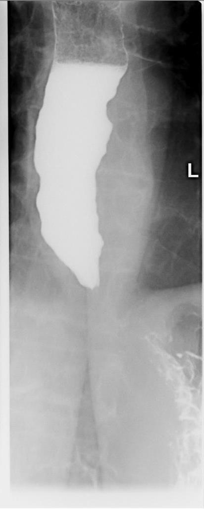 Esophageal disorders Case courtesy