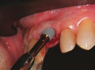Products & Practice Figure 5 Insertion of a NobelActive implant (4.