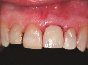 implant. Figure 7 Immediate provisional restoration of tooth No. 9 at time of surgery.