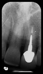 (Right) Postoperative periapical radiograph with the immediate temporary abutment and provisional