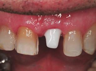 A definitive zirconia-based crown layered with feldspathic porcelain was then fabricated and