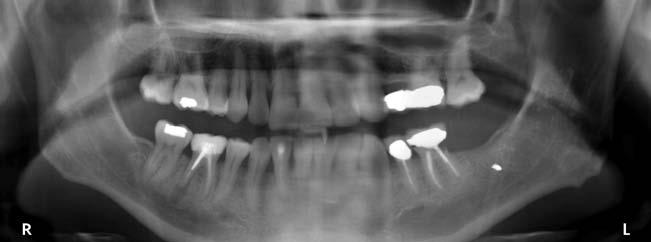 Products & Practice in the successful immediate restoration of a fractured anterior tooth. Figure 13 Preoperative panorex of nonrestoreable tooth No.