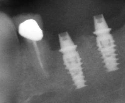 was a good candidate for an immediate molar extraction, immediate implant placement, and immediate provisional restoration.