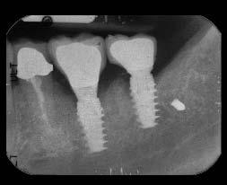 Two NobelActive RP 5-mm x 10-mm implants were then placed in the osteotomies in the sites of teeth Nos. 19 and 18 (Figure 14).