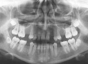 Orentlicher and Teich This case is an example of the use of the NobelActive implant for immediate molar extraction, immediate implant placement, and