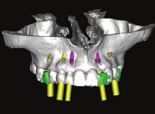 The implant has high initial stability in some molar extraction sites and other difficult bony defects that traditionally would not be considered