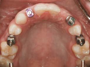 Because the patient presented with multiple congenitally missing teeth and the clinical and radiographic examinations revealed potential atrophy of the
