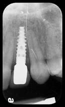 While wearing this radiographic guide, the patient received a second CT scan (Figure 24). Implant placement in the areas of teeth Nos.
