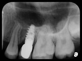 Four months after the grafting procedures, a NobelGuide was used to guide the depth, position, and angulations of the implant osteotomies. NobelActive implants were placed in sites of Nos.