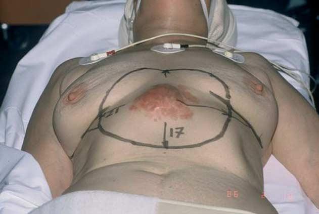 Aesthetic surgery techniques after excision of dermatofibrosarcoma protuberans: a case report 557 Figure 2 Immediate preoperative view showing the excision area (17!21 cm 2 ).
