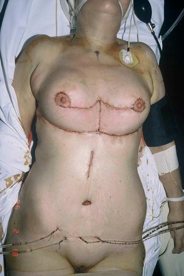 As a preliminary step to mammaplasty, the cephalad portion of the defect was closed with a bilateral advancement flap of the lower outer quadrants of the breast combined with a bilateral Z-plasty