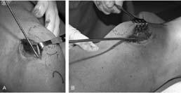 5mm Proximal to Patella Extend Med or Lat if