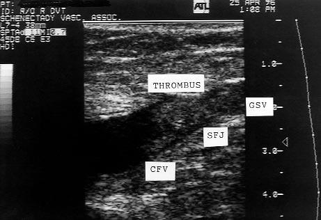 340 Blumenberg et al. February 1998 Fig. 1. Thrombus originating in GSV extending to SFJ and then to CFV. Table I.