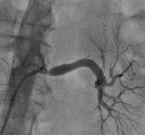 Bare metal stent restenosis To get the best