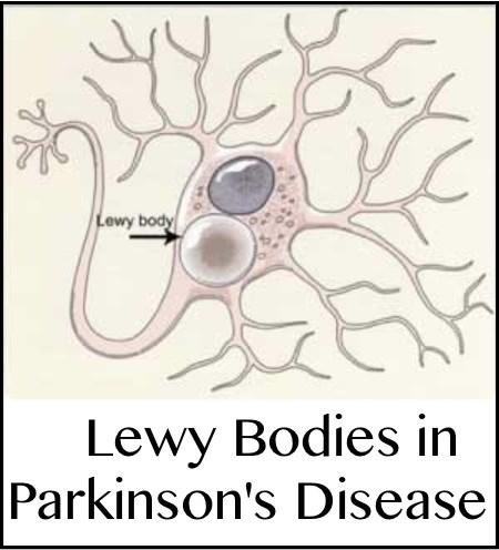 Example of treatment target requiring precise diagnosis: Lewy body: Aimed at