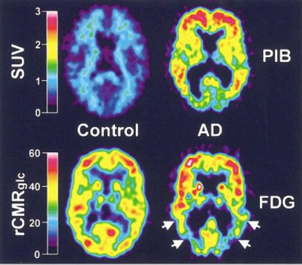 First PET scans for amyloid: Klunk