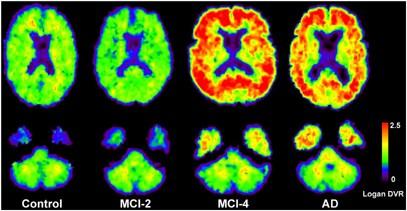 Amyloid imaging permits identification of MCI subjects who have brain