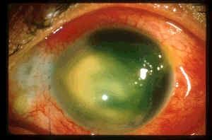 Sclerokeratoplasty David S. Chu, M.D. Cases Case 1 40 year-old female from Peru presented to our Service with inflamed OS for 2 months duration.