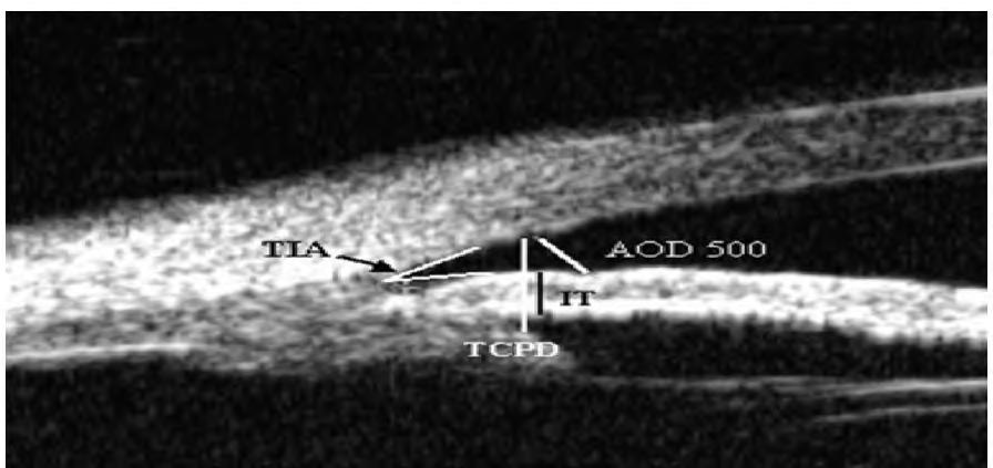 (A) Safwat Elkady 115 The AOD 500 is the distance between the posterior corneal surface and the anterior iris surface measured on a line perpendicular to the trabecular meshwork 500µm from the