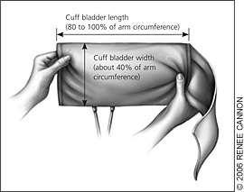 Blood Pressue Measurement Bladder width that is at least 40% of the child's midarm