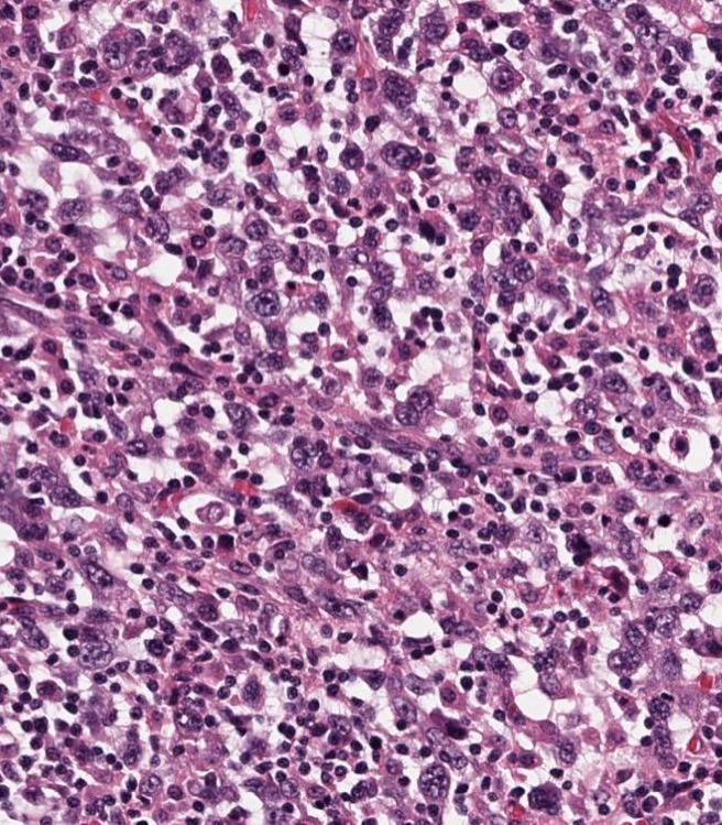 Resection: Pleomorphic carcinoma with giant cell
