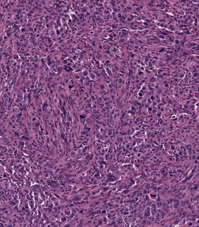 fluid: Adenocarcinoma with giant cell features