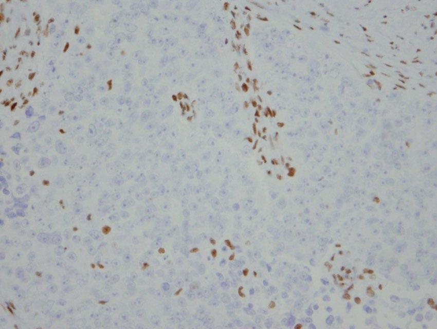 Our patient s SMARCA4 IHC: Differential diagnosis: Newly described SMARCA4-deficient thoracic malignancy No evidence of lung-specific differentiation SOX2 amplification and overexpression is common