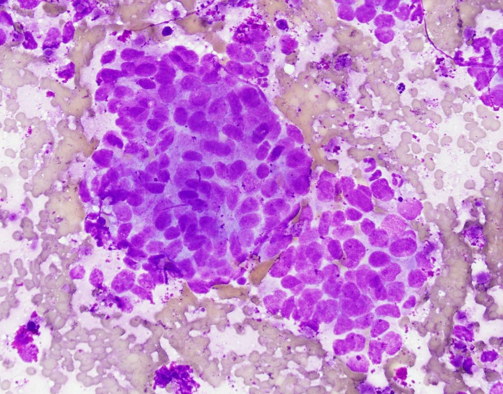 Case 1: What is your favored diagnosis? 1. Non small cell carcinoma, NOS 2. Squamous cell carcinoma 3.