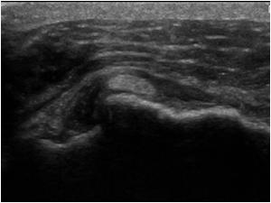 MRI of the Shoulder Benefits of Ultrasound: * Dynamic * Interactive