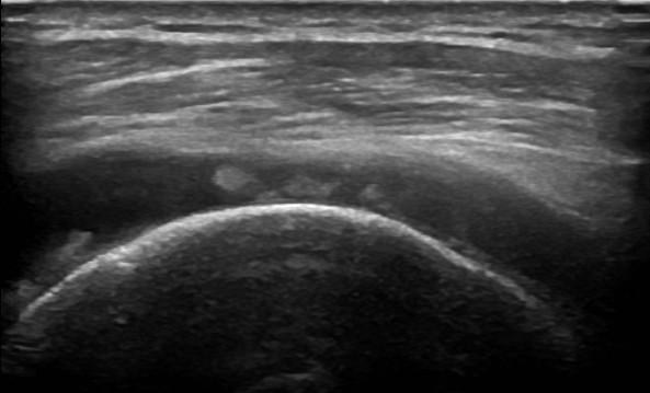 MRI of the Shoulder Role of Ultrasound * Fluid Collections (Joint effusions,