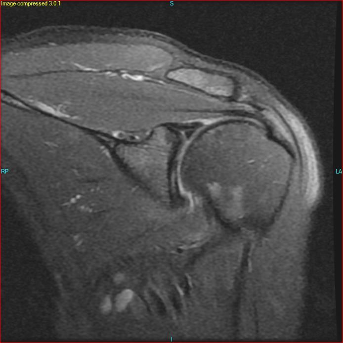 MRI of the Shoulder MRI Sequences for Joint Evaluation * Proton Density (PD) fluid