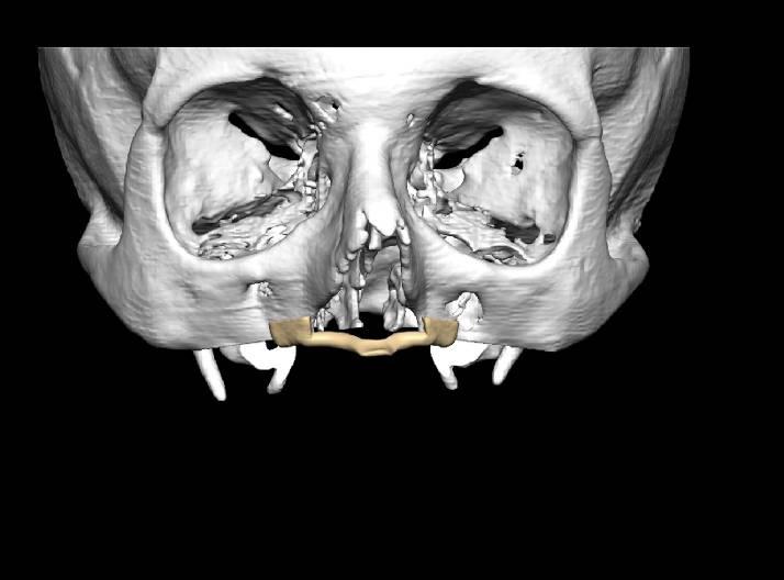 Surgical Guide Case 1 This case was planned on CT data using 3D CAD It