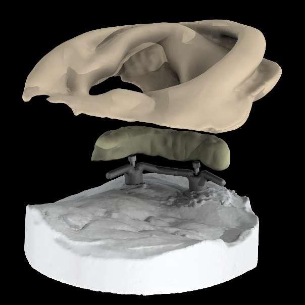 Prosthetic Retention Soft tissue, facial prosthesis design using scan data and FreeForm