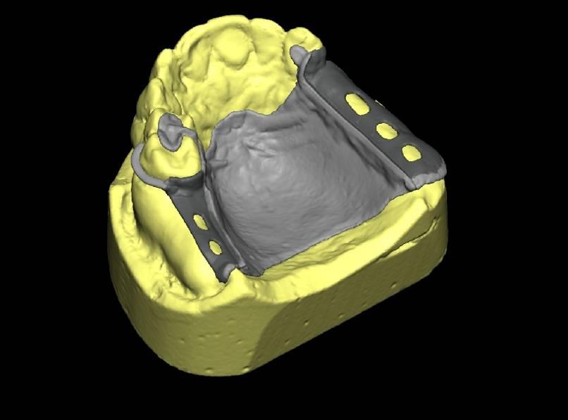 RPD Case 1 Designed on 3D patient data using SensAble FreeForm software Designed according to