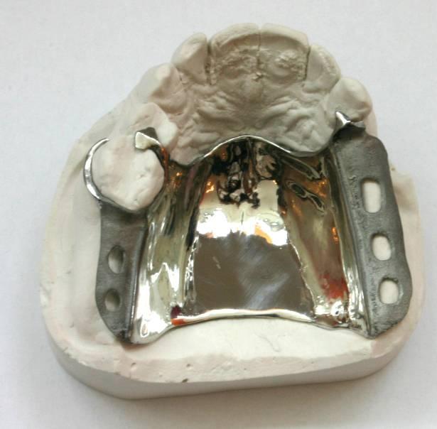 RPD Case 1 Made using SLM in F75 Co-Cr Fitted the patient cast very well Polishing revealed