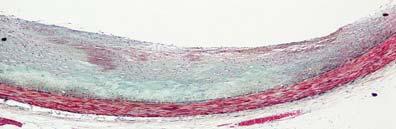 foam cells Extracellular lipid