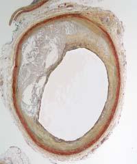 Calcified plaque Hemorrhage Thrombus