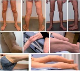 2010;86:213-221 Jarry et al Brain 2007;130:368-380 LGMD2L A-D Atrophy of thighs & medial gastrocs E Biceps atrophy F-H