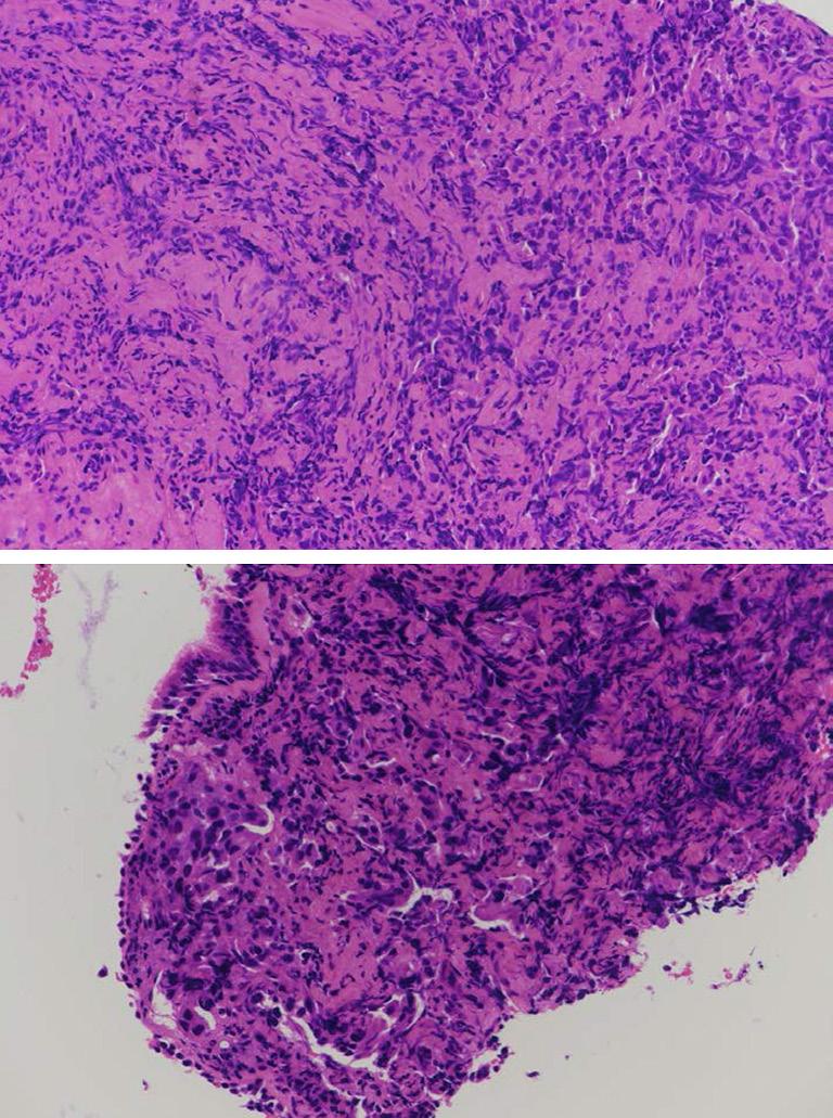 E740 Zhang et al. CSCLC responses to EGFR-TKI A B Figure 1 Representative morphology of the mixture of small cell carcinoma and adenocarcinoma (hematoxylin-eosin staining, 20 ).