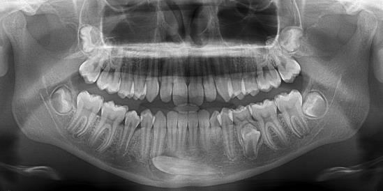 3. An anterior occlusal and a periapical radiograph taken with a 30⁰ tube shift, once again using horizontal parallax.