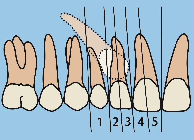(Figure 9). The analysis was described by Ericson and Kurol 16 and the five canine positions are: 1. Normally positioned 2. Distal half of the lateral incisor root overlapped by the canine crown 3.