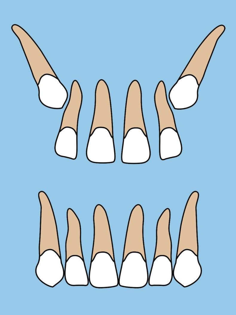 Figure 1 - Physiological spacing of the upper labial segment prior to the eruption of the upper canines.
