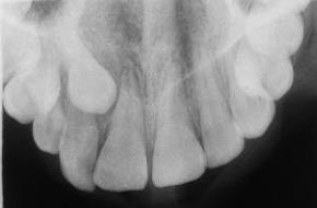 A permanent canine remains unerupted more than 6 months after the eruption of the contralateral tooth. 4.