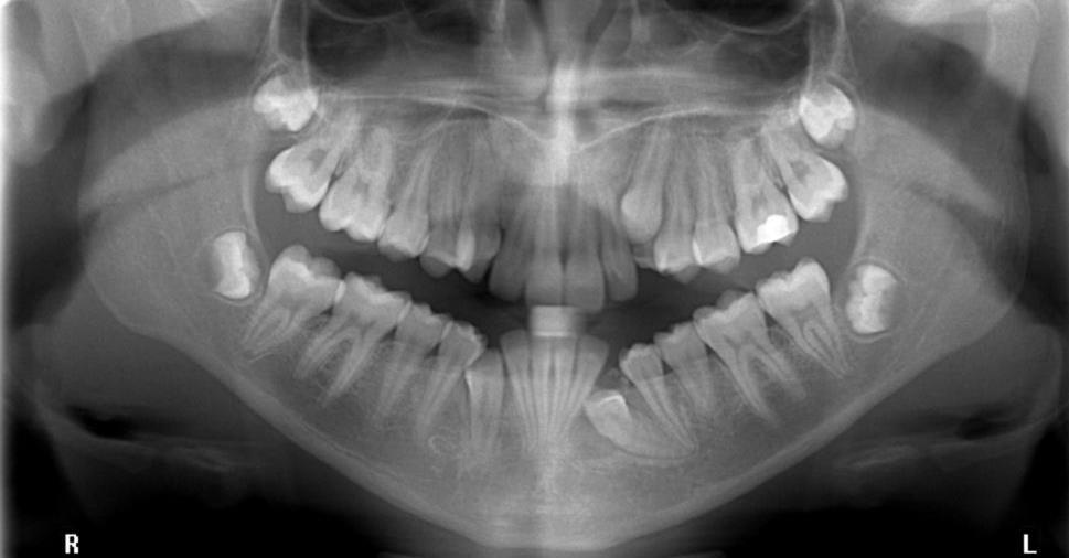 Figure 5 an OPT and lower standard occlusal radiograph where the lower left canine is impacted against the root of the lateral incisor, within the line of the arch.