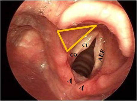 Bounded: Anteriorly: upper border of the epiglottis (E) Posteriorly: Arytenoid (A) Laterally: Aryepiglottic folds (AEF) The laryngeal cavity