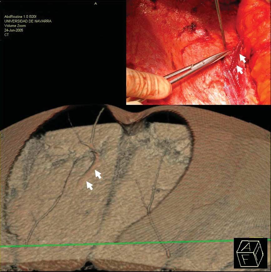 The location and course of the superficial inferior epigastric artery (arrows) was also described and reported as well as the anatomical variation of a