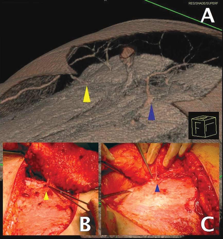 Preoperative MSCT for DIEAP planning 591 Figure 6 Representative 3D-VR image with surgical findings correlation.